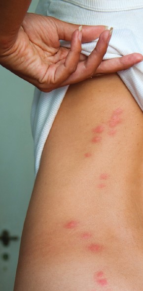Woman pulling up shirt to reveal bed bug bites on back