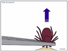 Pulling a tick out of the skin, using tweezers. Pulling directly up at a 90 degree angle.