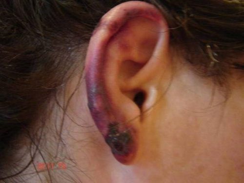 Sample of early phase skin lesion on an ear