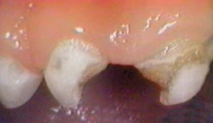 two front teeth with lateral half of each too missing and yellow-brown indented areas extending halfway down what is remaining of the teeth