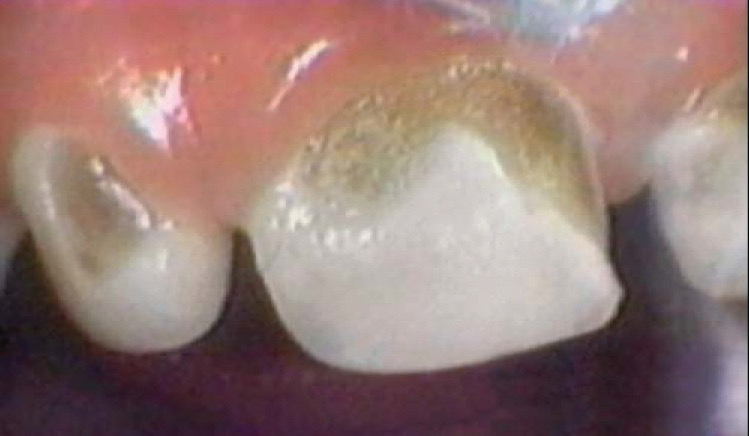 Front teeth with indented brown and yellow near the gum line