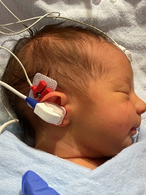 A sleeping newborn baby receiving a newborn hearing screen with sticker electrodes.