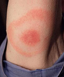 A skin rash of erythema