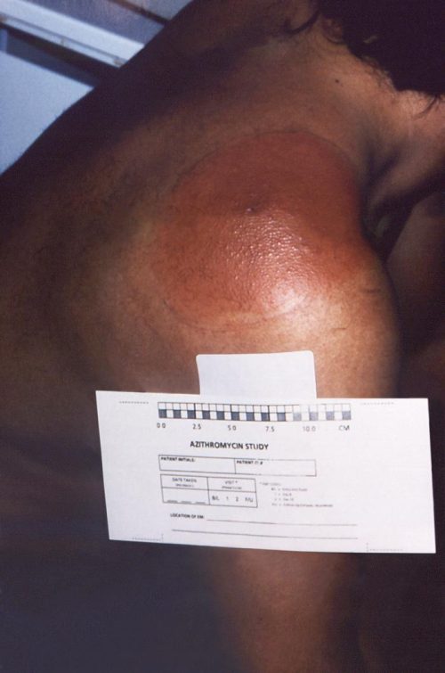 right posterior shoulder region of a patient who had presented with an erythema migrans (EM) rash